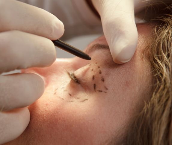 foto de una blefaroplastia