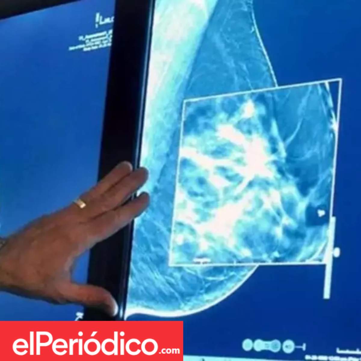 mastectomías
